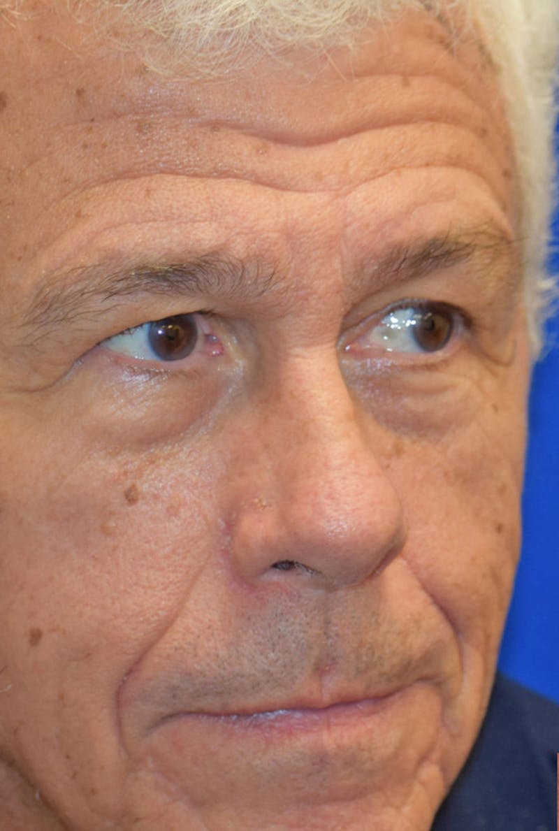 Face Before & After Gallery - Patient 63361005 - Image 3