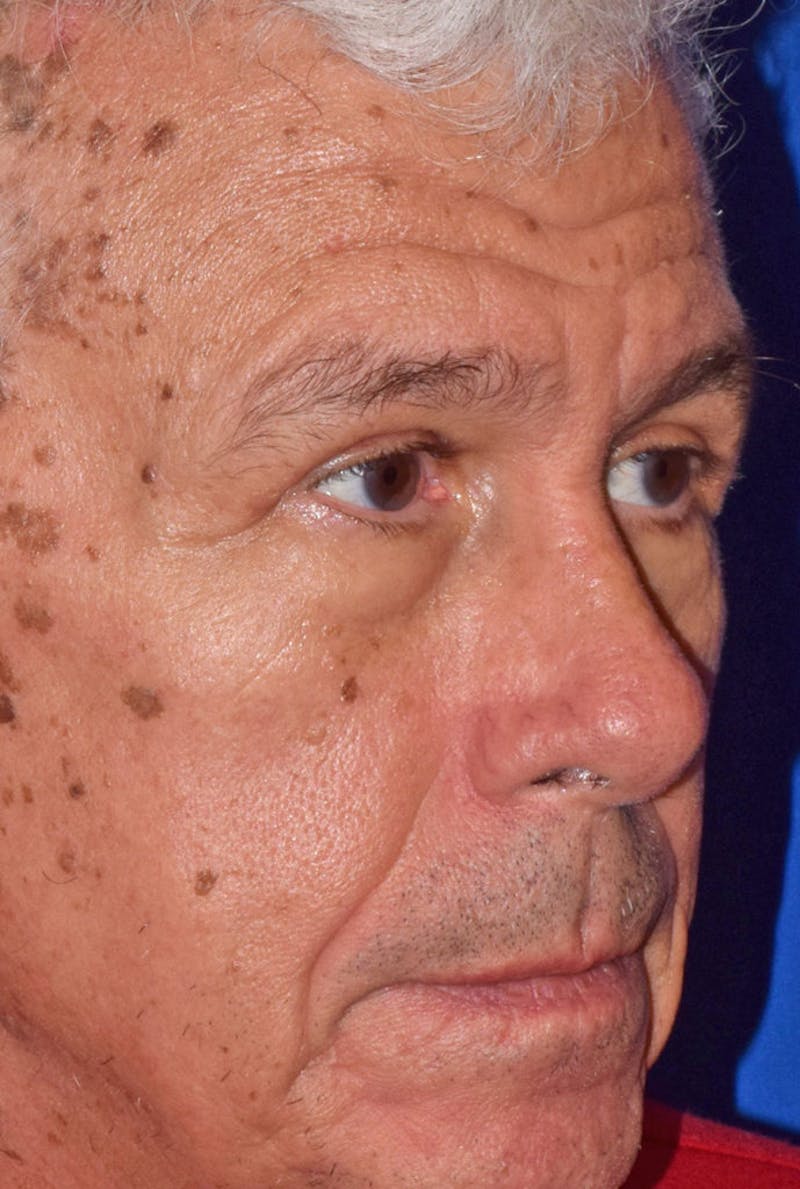 Face Before & After Gallery - Patient 63361005 - Image 4
