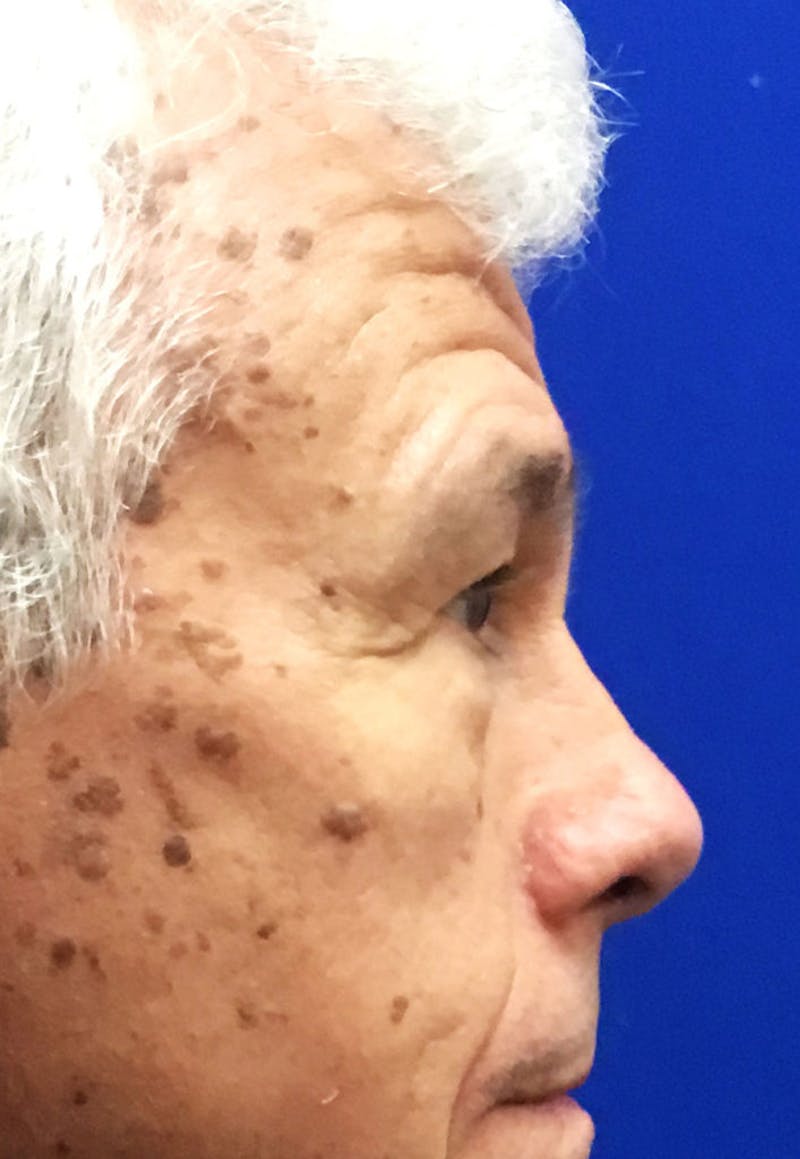 Face Before & After Gallery - Patient 63361005 - Image 5