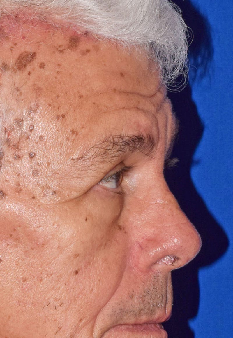 Face Before & After Gallery - Patient 63361005 - Image 6