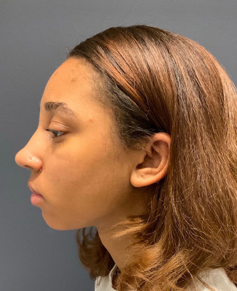 Face Before & After Gallery - Patient 63361014 - Image 8