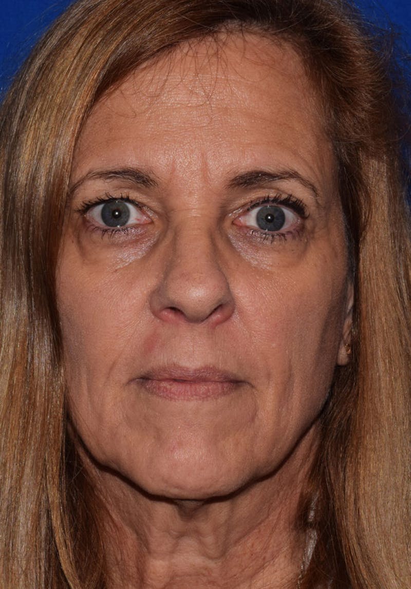 Face Before & After Gallery - Patient 63361022 - Image 1