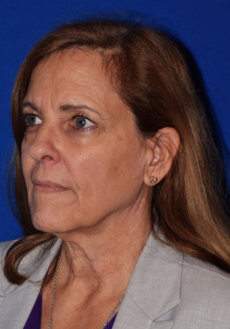 Face Before & After Gallery - Patient 63361022 - Image 3
