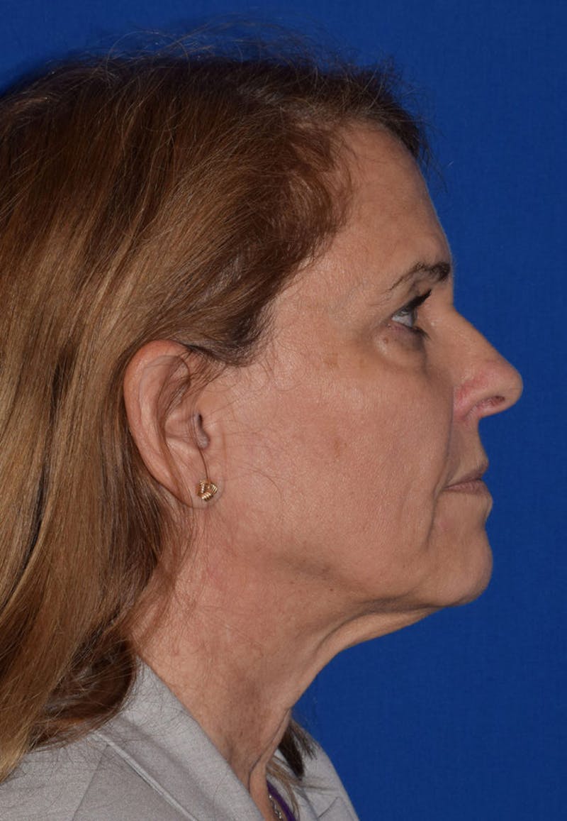 Face Before & After Gallery - Patient 63361022 - Image 5