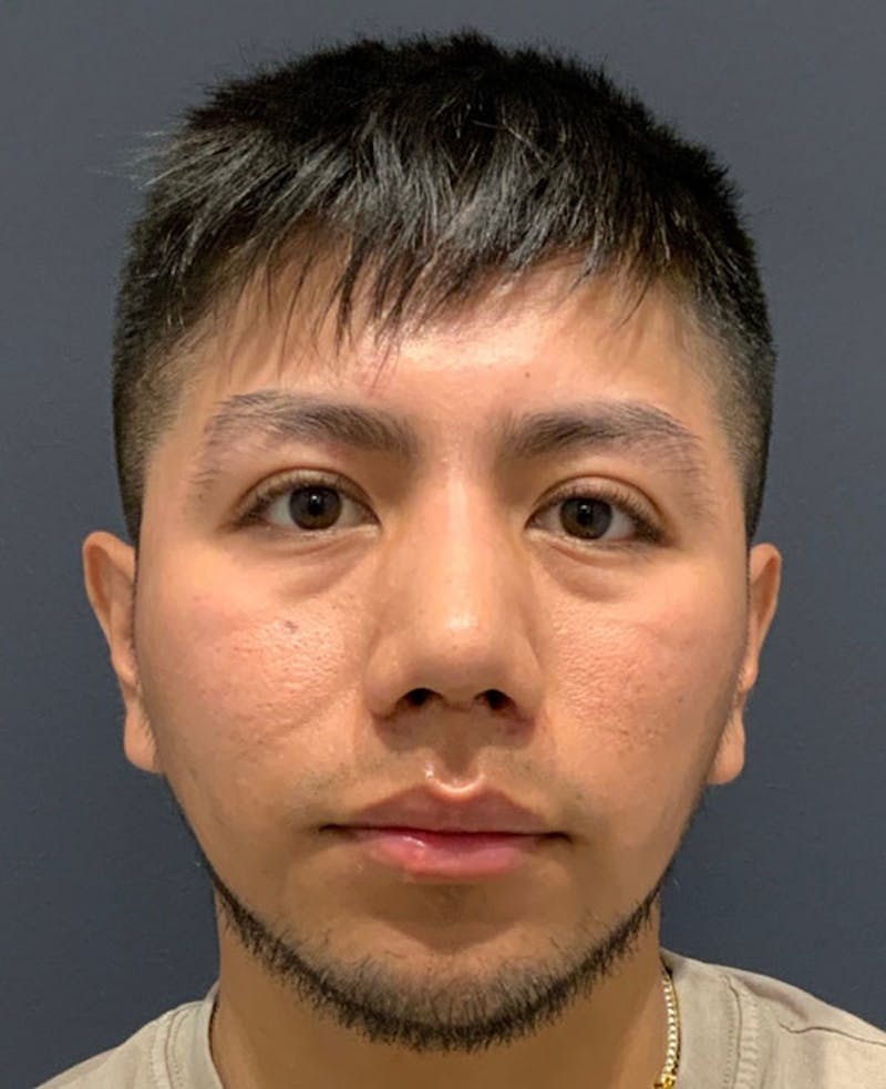 Cosmetic Surgical Before & After Gallery - Patient 63361042 - Image 2