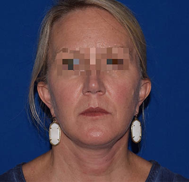 Face Before & After Gallery - Patient 63361047 - Image 2