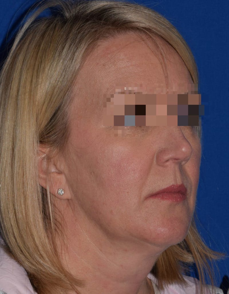 Face Before & After Gallery - Patient 63361047 - Image 3