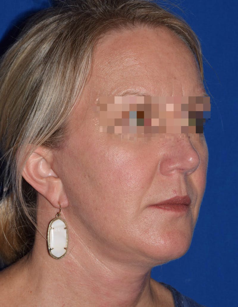 Face Before & After Gallery - Patient 63361047 - Image 4