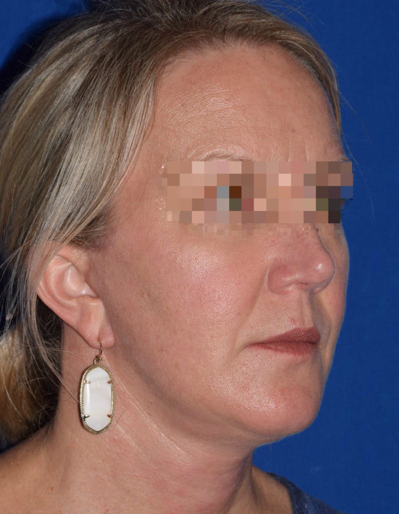 Cosmetic Surgical Before & After Gallery - Patient 63361047 - Image 4