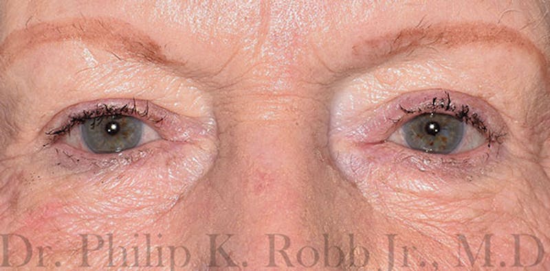 Cosmetic Surgical Before & After Gallery - Patient 63361052 - Image 2