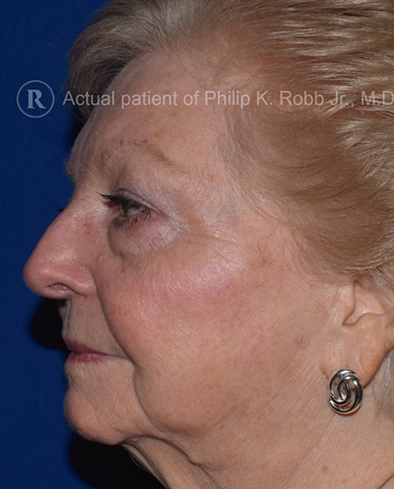 Cosmetic Surgical Before & After Gallery - Patient 63361071 - Image 3