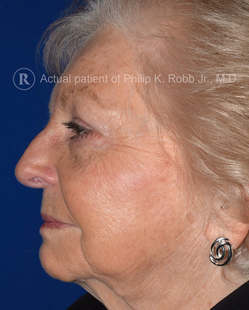 Cosmetic Surgical Before & After Gallery - Patient 63361071 - Image 4