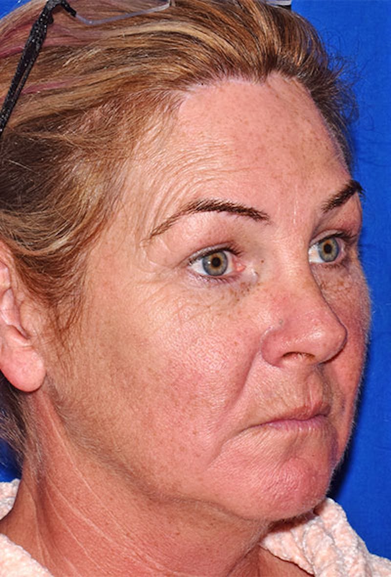 Face Before & After Gallery - Patient 63361074 - Image 1