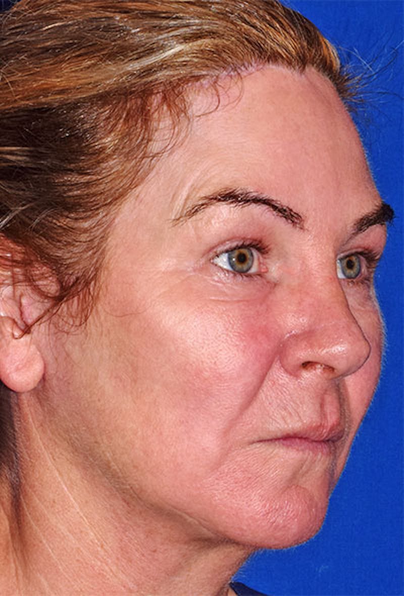 Face Before & After Gallery - Patient 63361074 - Image 2