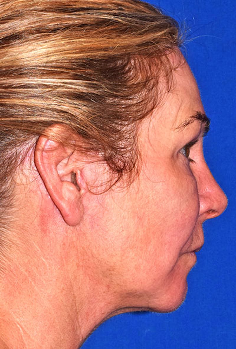 Face Before & After Gallery - Patient 63361074 - Image 4