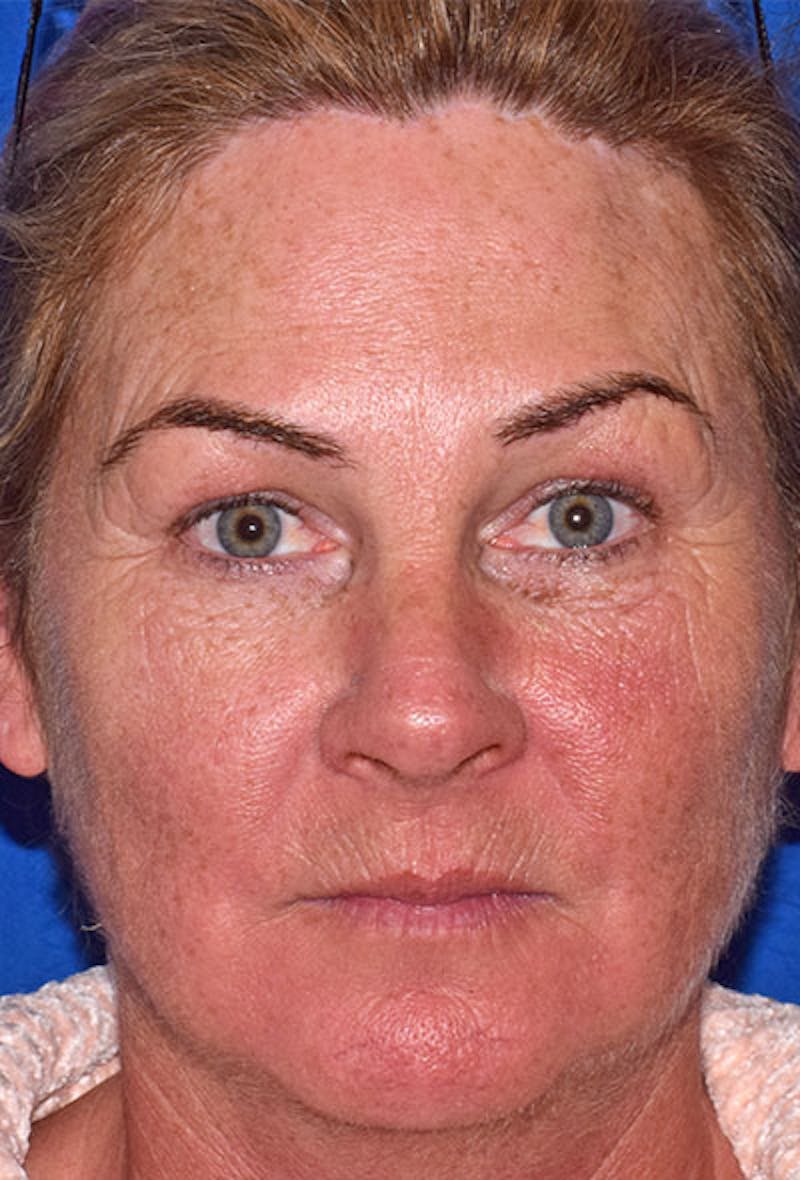 Face Before & After Gallery - Patient 63361074 - Image 5