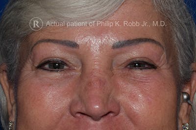 Face Before & After Gallery - Patient 63361095 - Image 2