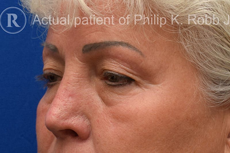 Cosmetic Surgical Before & After Gallery - Patient 63361095 - Image 3