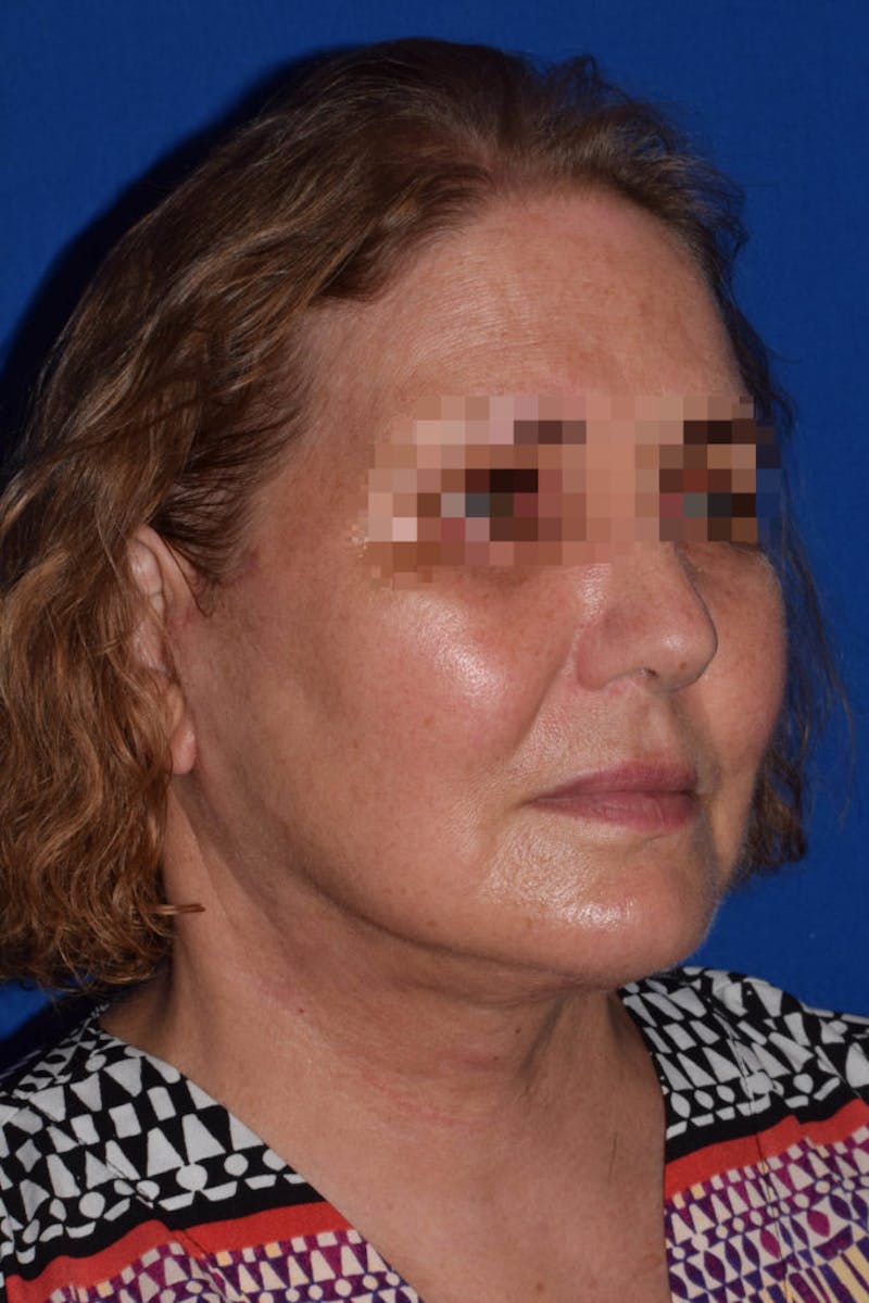 Face Before & After Gallery - Patient 63361102 - Image 4