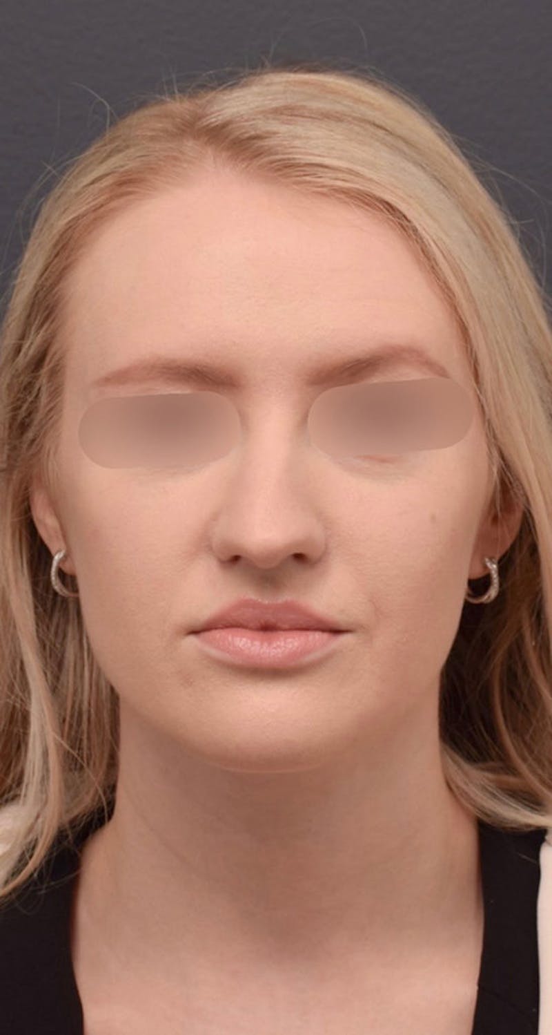 Cosmetic Surgical Before & After Gallery - Patient 63361110 - Image 1