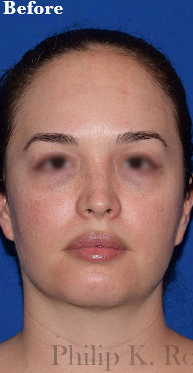 Face Before & After Gallery - Patient 63361118 - Image 1