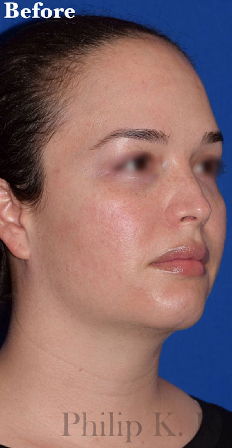 Face Before & After Gallery - Patient 63361118 - Image 3