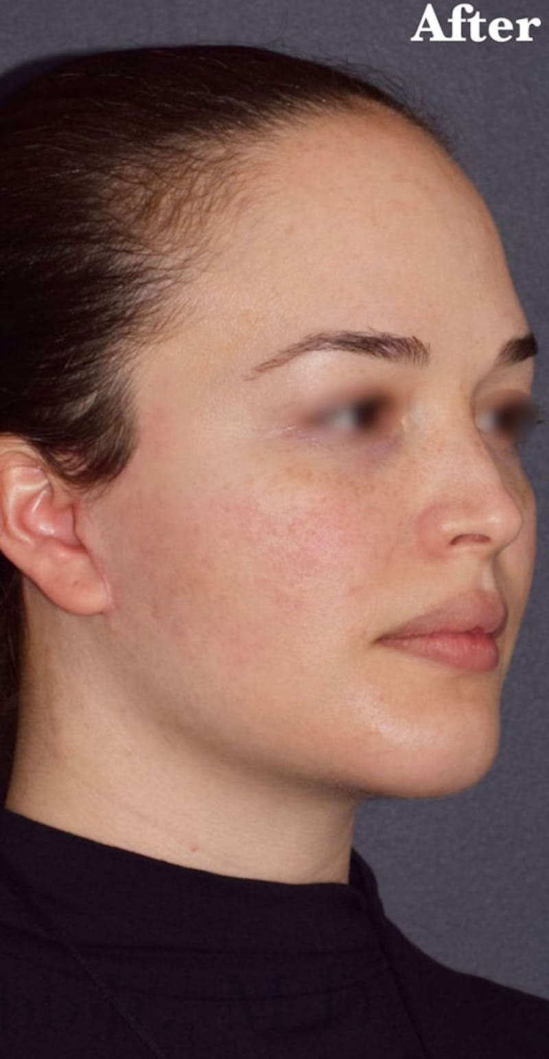 Face Before & After Gallery - Patient 63361118 - Image 4