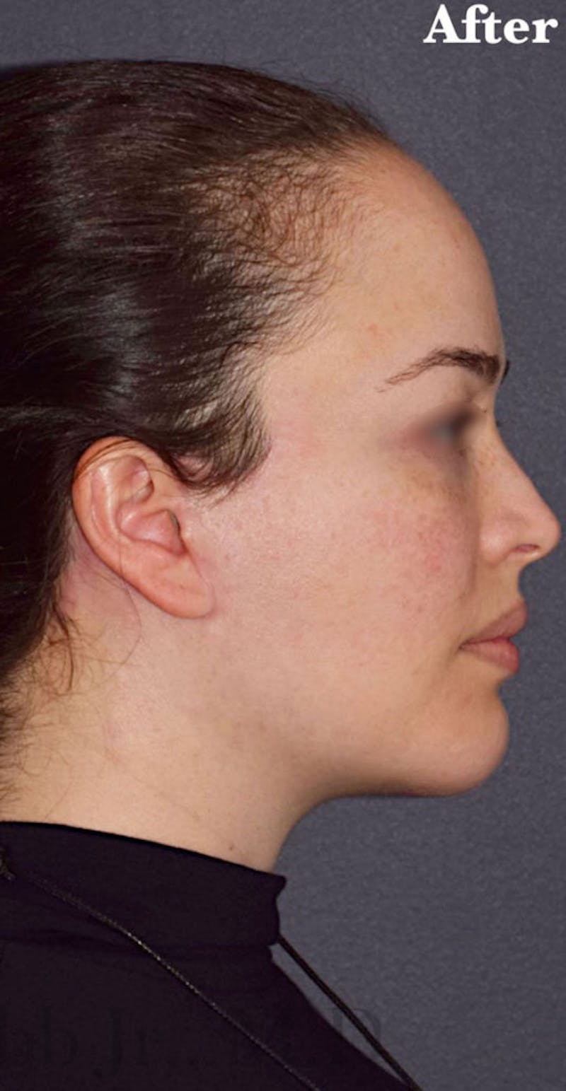 Face Before & After Gallery - Patient 63361118 - Image 6