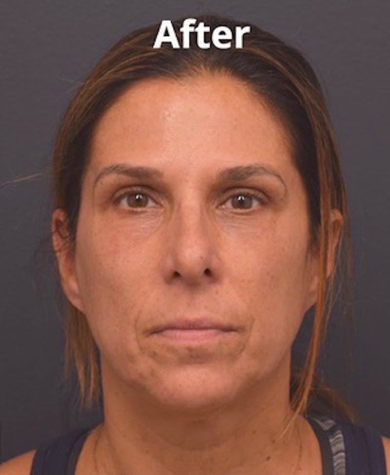 Face Before & After Gallery - Patient 63361125 - Image 2
