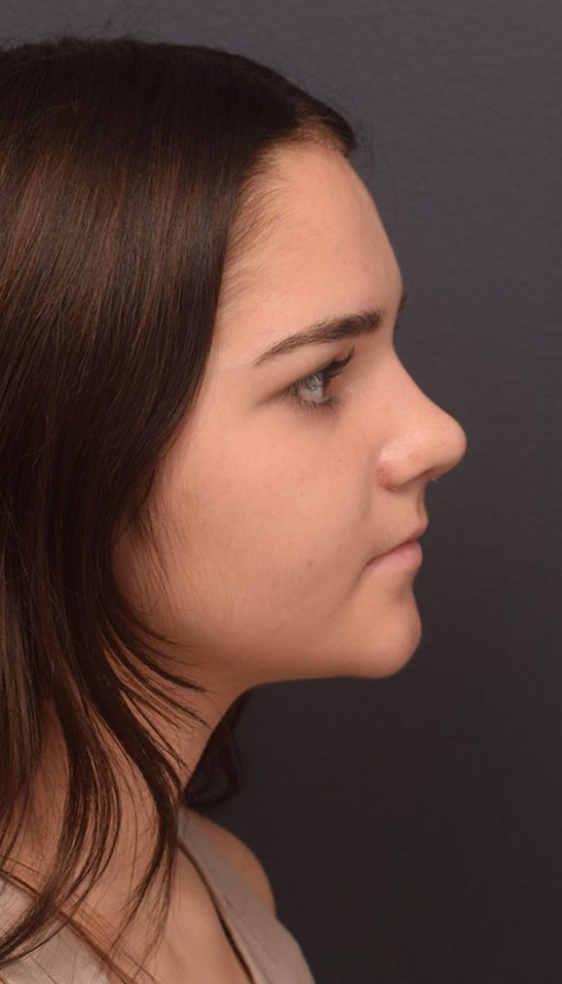Cosmetic Surgical Before & After Gallery - Patient 63361137 - Image 6