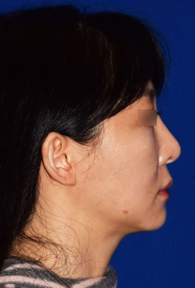 Cosmetic Surgical Before & After Gallery - Patient 63361149 - Image 1