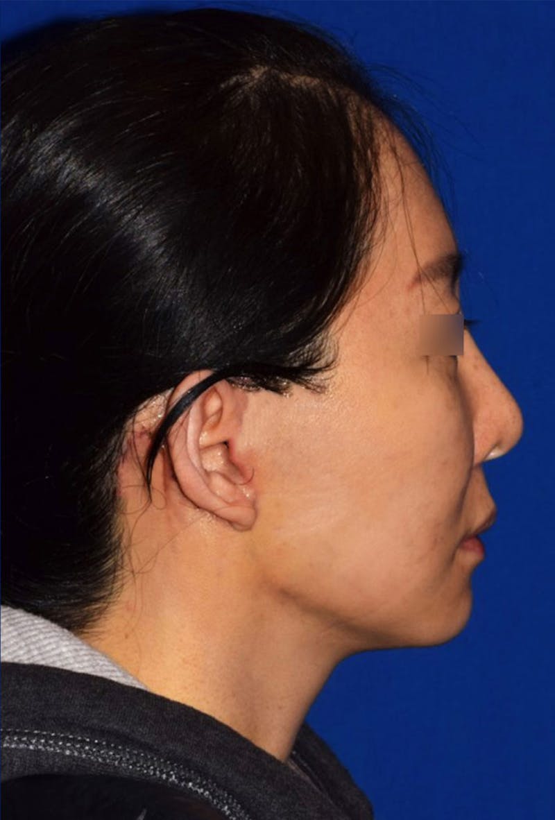 Cosmetic Surgical Before & After Gallery - Patient 63361149 - Image 2