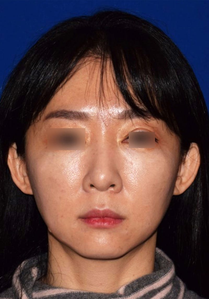 Cosmetic Surgical Before & After Gallery - Patient 63361149 - Image 5