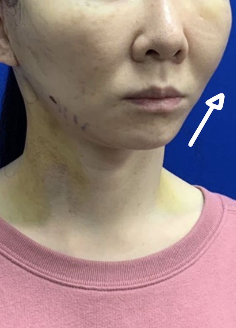 Face Before & After Gallery - Patient 63361149 - Image 10