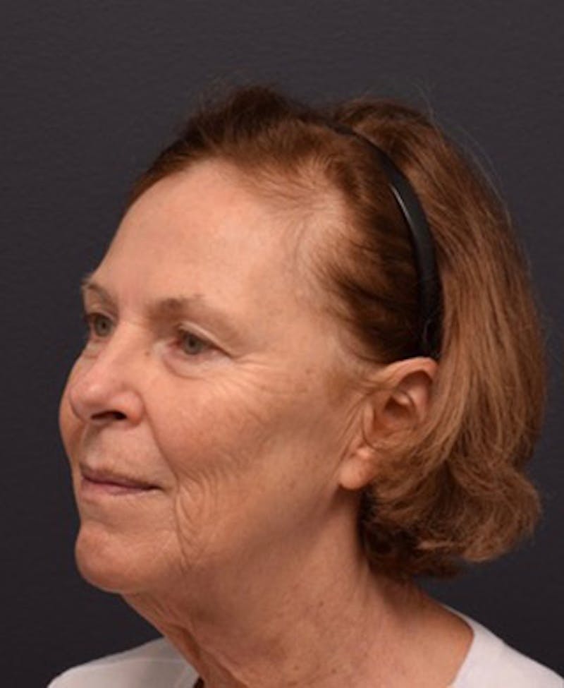 Face Before & After Gallery - Patient 63361154 - Image 3