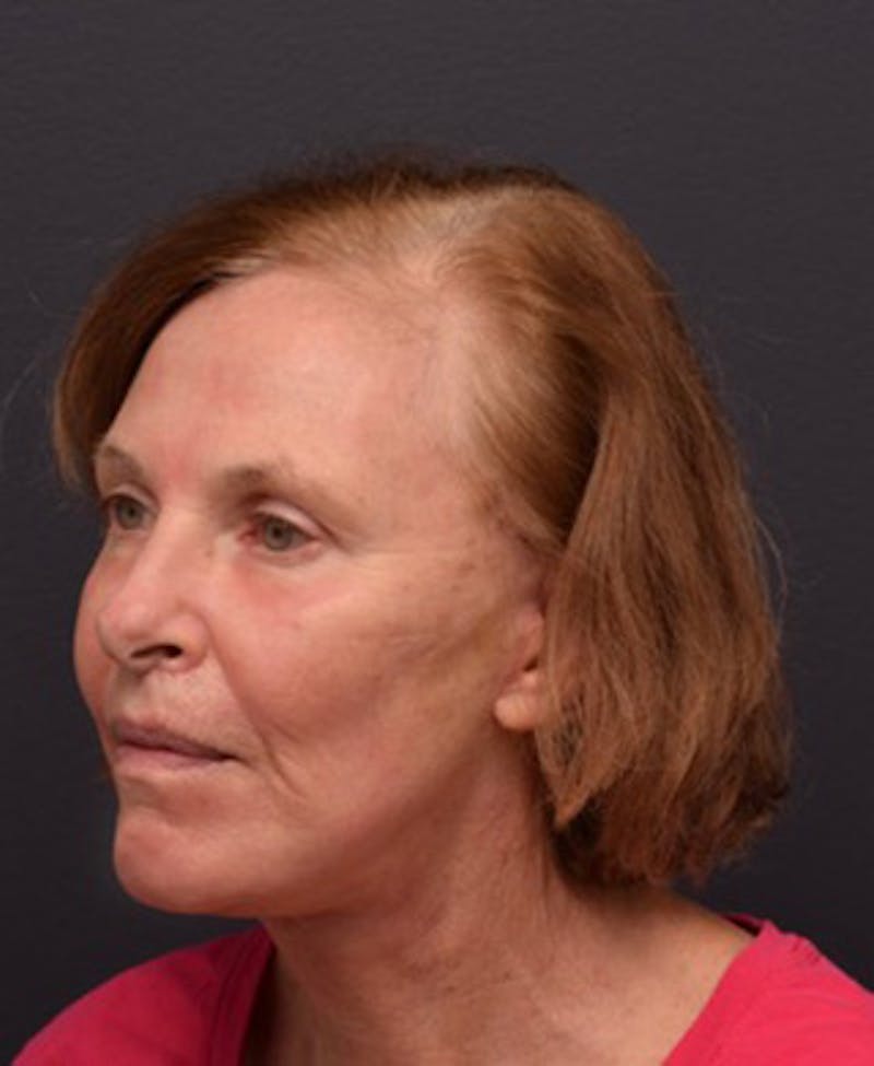 Face Before & After Gallery - Patient 63361154 - Image 4
