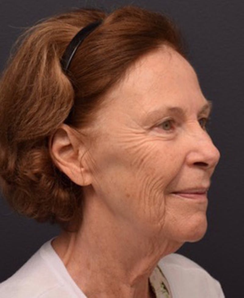 Face Before & After Gallery - Patient 63361154 - Image 5