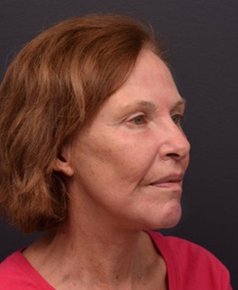 Cosmetic Surgical Before & After Gallery - Patient 63361154 - Image 6