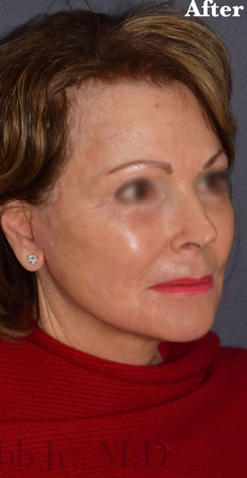 Face Before & After Gallery - Patient 63361168 - Image 2