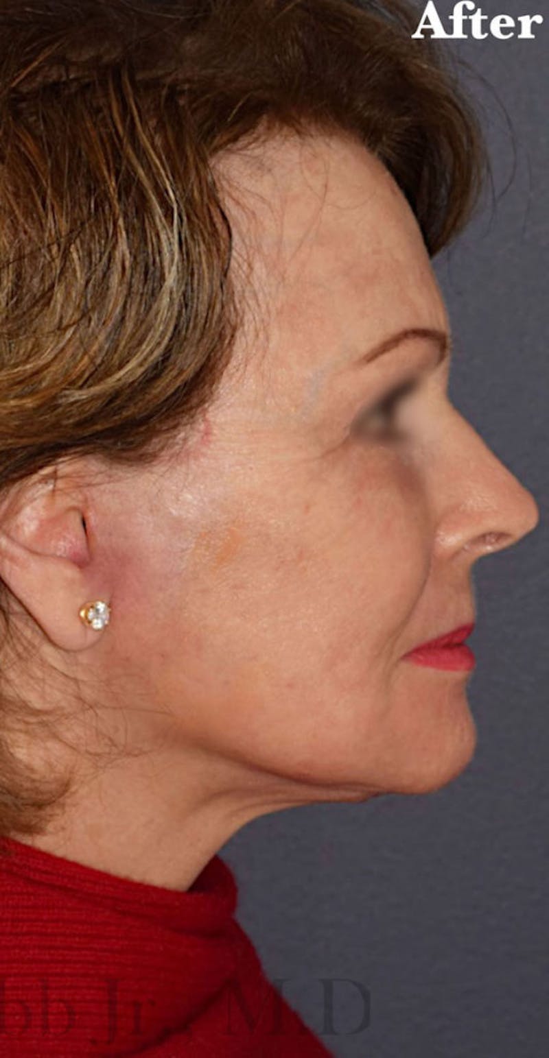 Face Before & After Gallery - Patient 63361168 - Image 4