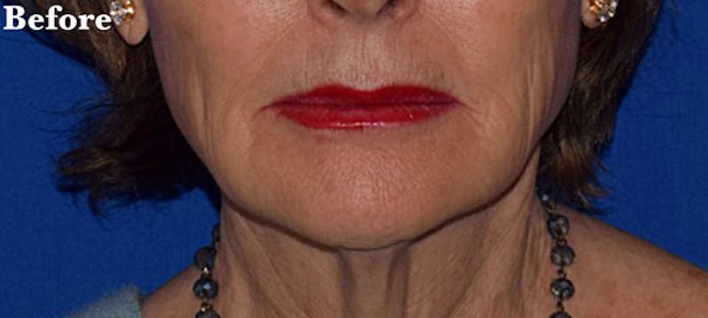 Face Before & After Gallery - Patient 63361168 - Image 5