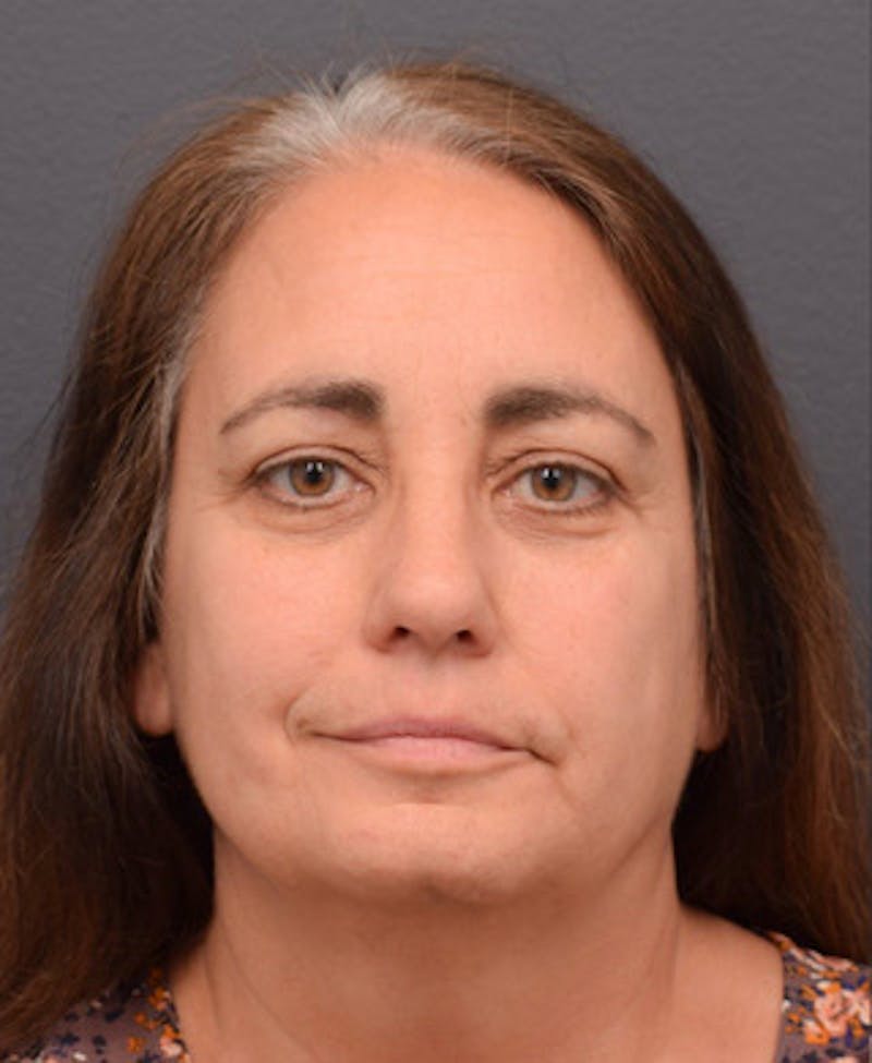 Face Before & After Gallery - Patient 63361175 - Image 1