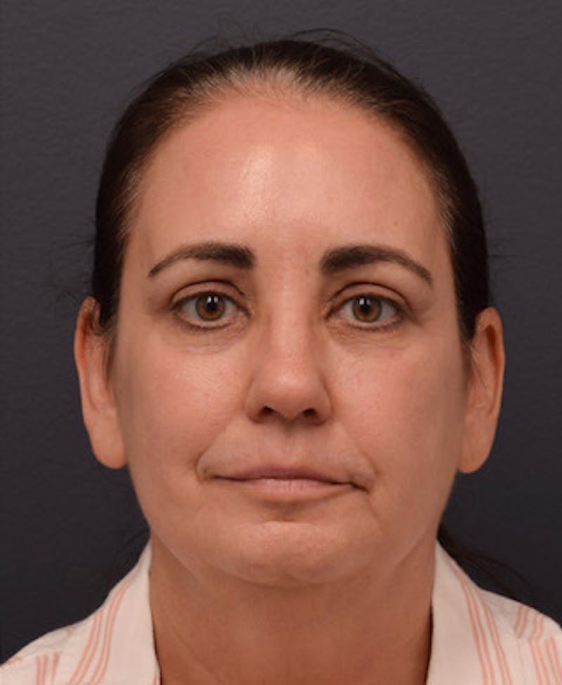 Face Before & After Gallery - Patient 63361175 - Image 2