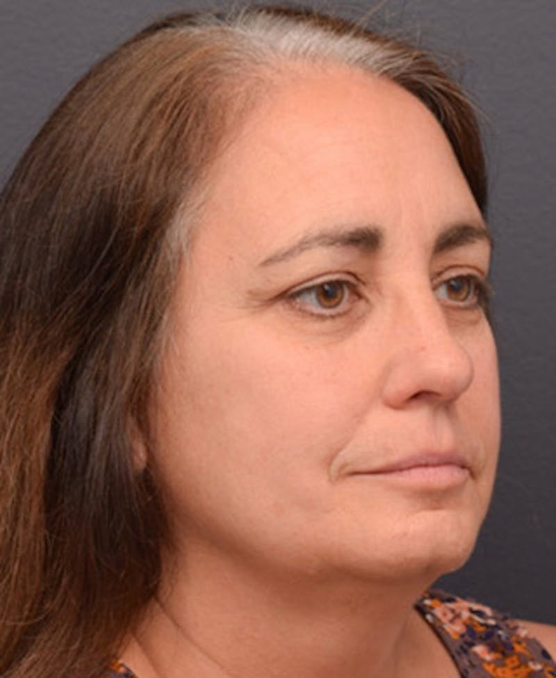 Face Before & After Gallery - Patient 63361175 - Image 5