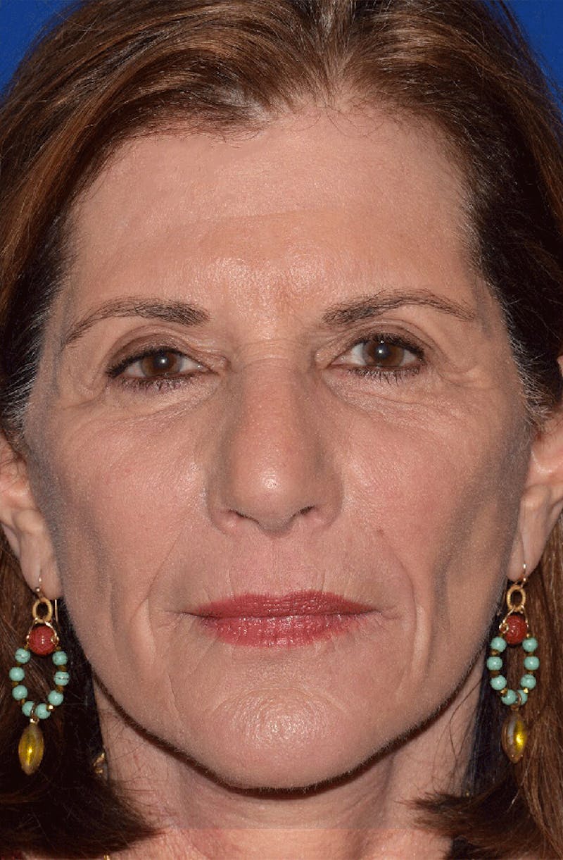 Face Before & After Gallery - Patient 63361182 - Image 2
