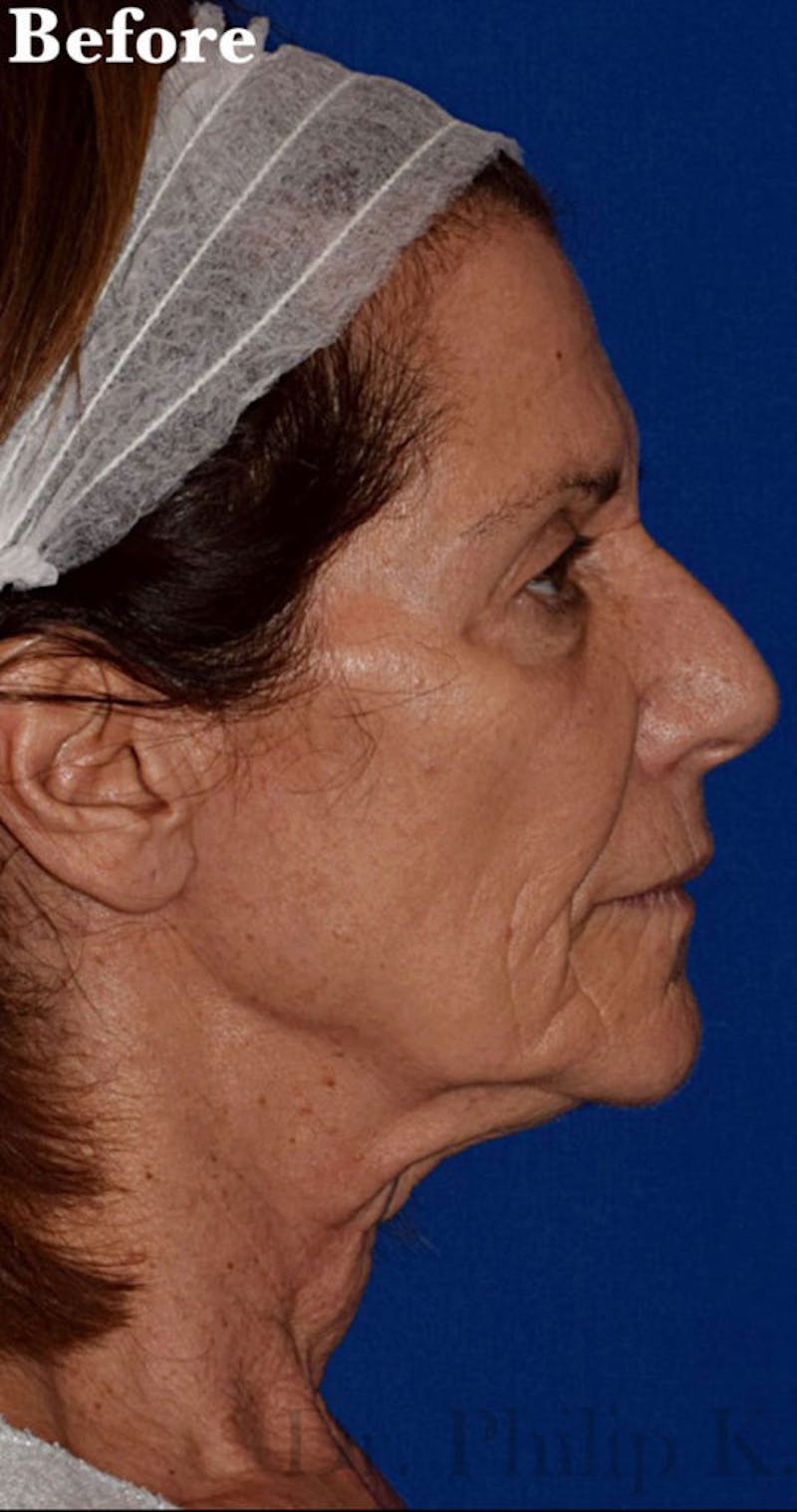 Face Before & After Gallery - Patient 63361182 - Image 5