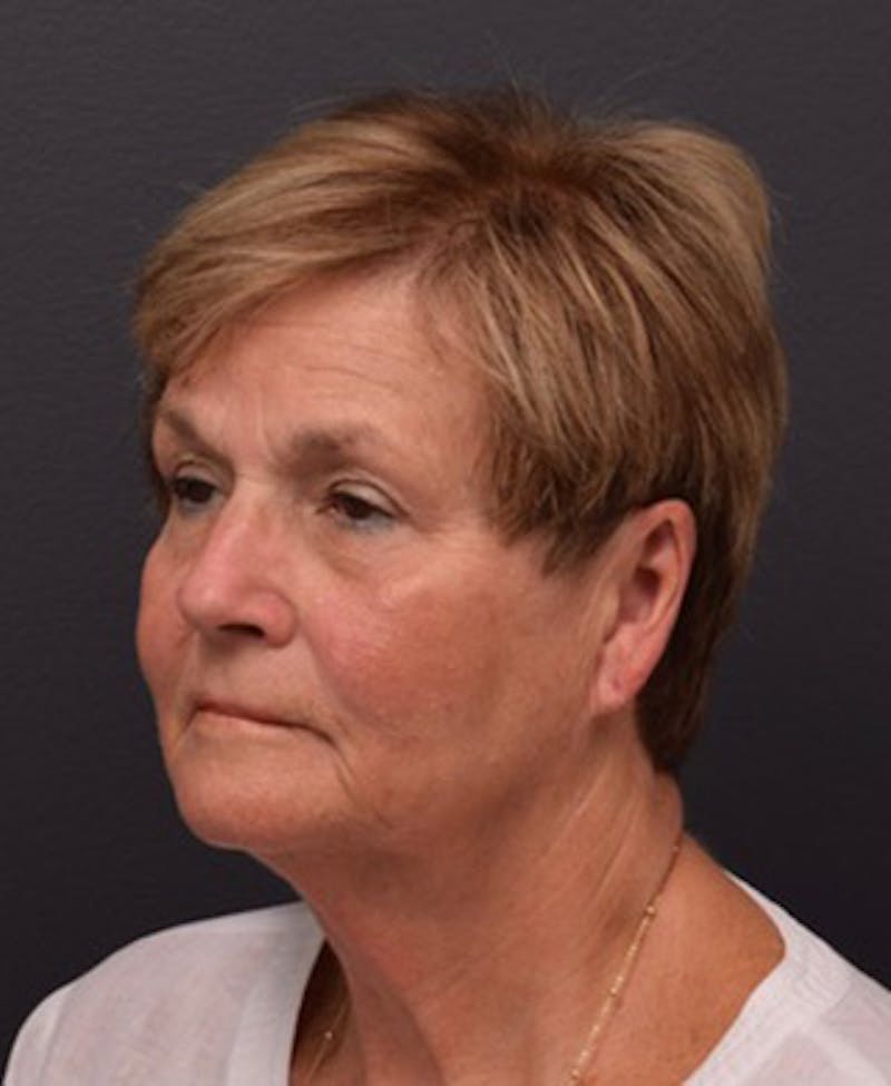 Face Before & After Gallery - Patient 63361189 - Image 3