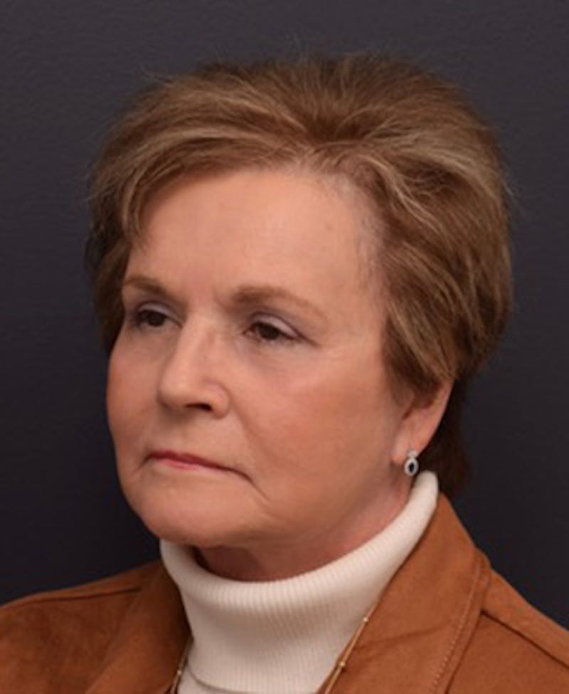 Face Before & After Gallery - Patient 63361189 - Image 4