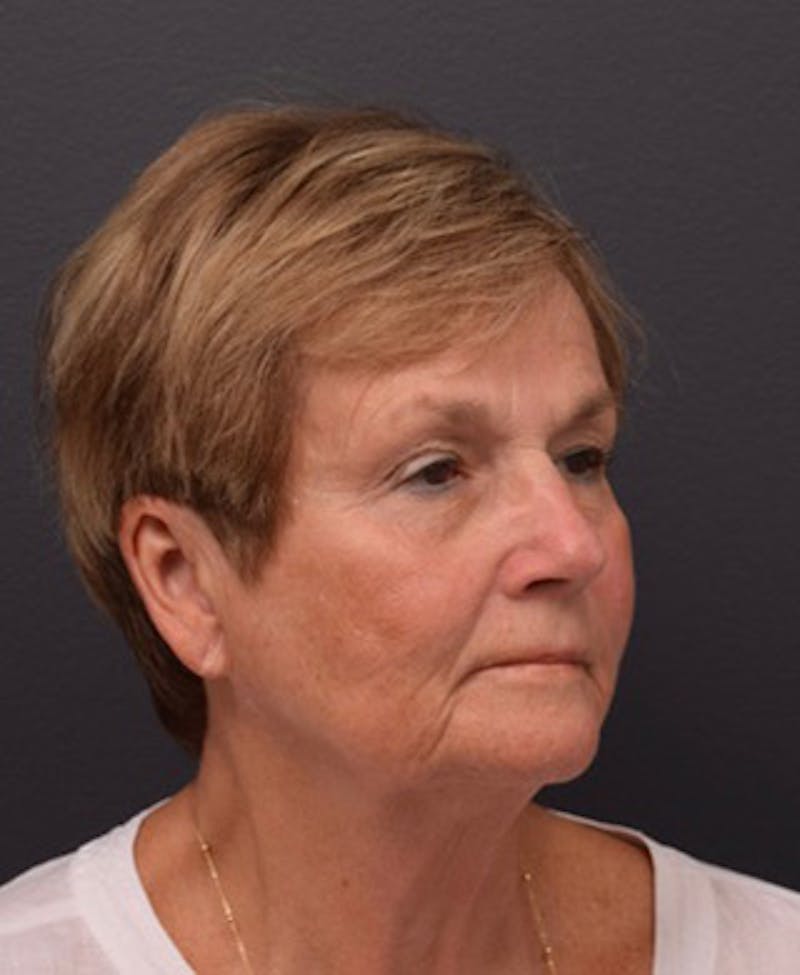 Face Before & After Gallery - Patient 63361189 - Image 5