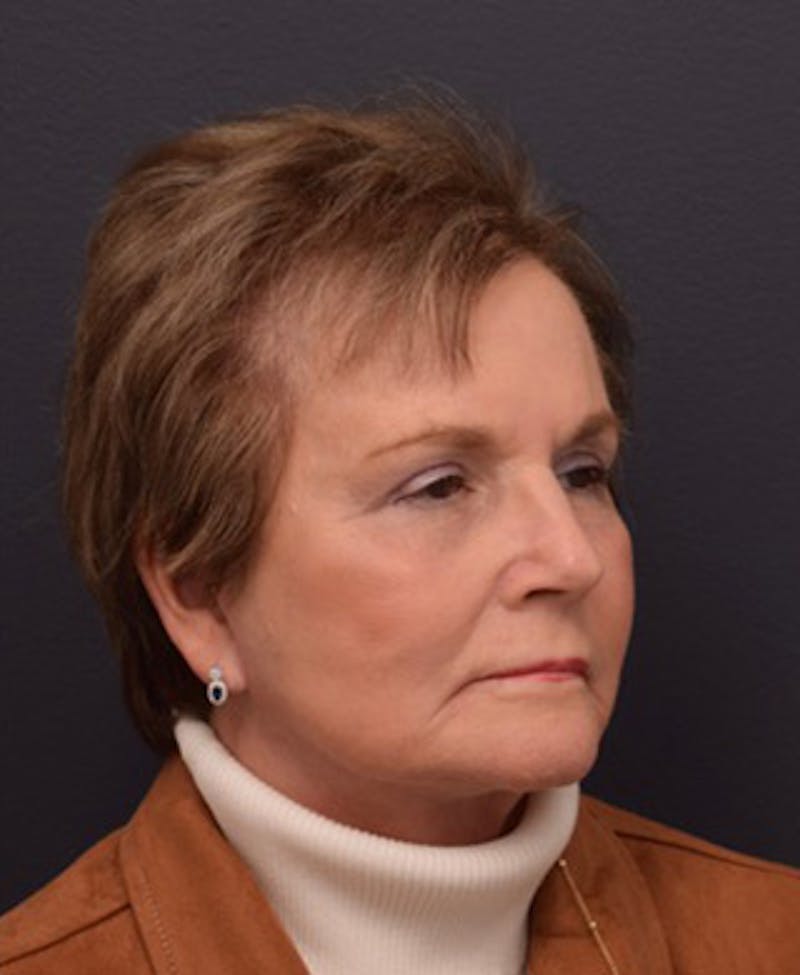 Face Before & After Gallery - Patient 63361189 - Image 6